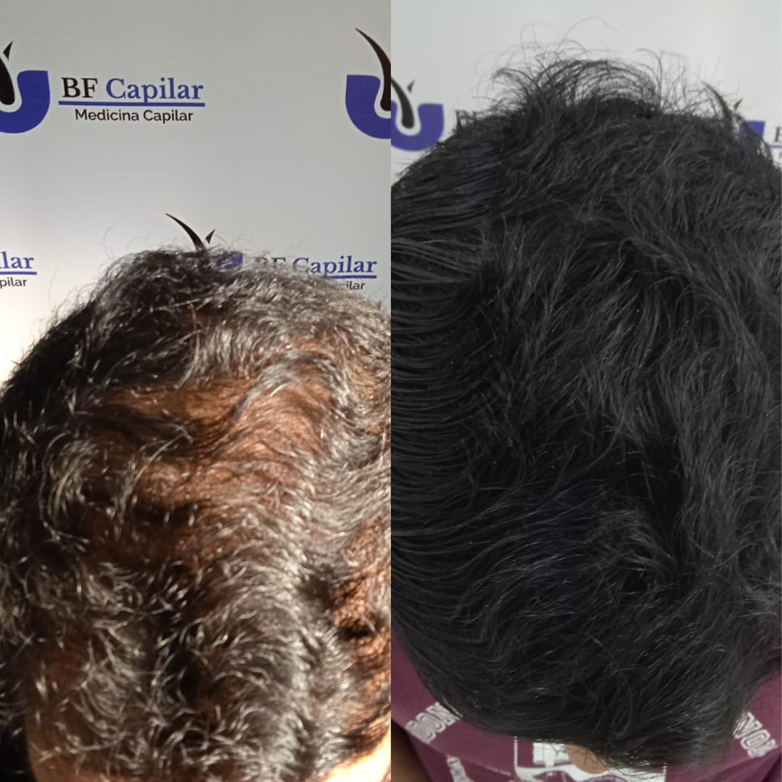 testimonio-de-tratamiendo-para-la-caida-del-cabello
